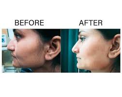 Other potential side effects are swelling, redness, and scarring. What Is Laser Hair Removal Pros Cons And Side Effects
