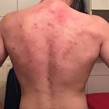 Hilfe Akne Am Rucken Was Tun Gesundheit Und Medizin Sport Und Fitness