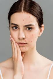 Image result for acne face