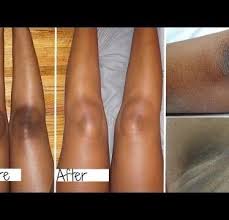 How to remove dark spots on knees. Dark Spot Remover On Body Legs And Tishwebebe Home Facebook