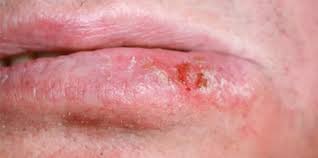 Image result for Lip Cancer