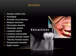 Image result for Alveolitis sicca)