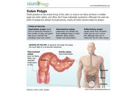 Know the symptoms so you can catch it early. Colon Cancer Causes Symptoms And Treatments Live Science