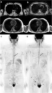 Unlike external beam radiation, these drugs can reach all the affected bones at the same time. Whole Body Magnetic Resonance Imaging Wb Mri Reporting With The Metastasis Reporting And Data System For Prostate Cancer Met Rads P Inter Observer Agreement Between Readers Of Different Expertise Levels Cancer Imaging Full Text