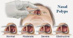 It is often accompanied by some additional treatment such as elimination of a mass, swelling or tumor. Nasal Polyps Surgery In Nj Nyc Sinus Surgeon Dr Tadros