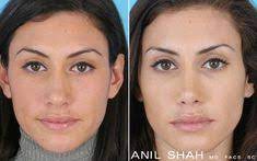 She clearly has had a nose job among other cosmetic procedures. 22 Female Rhinoplasty Before After Ideas Rhinoplasty Eye Lift Surgery Facial Plastic