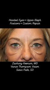 Festoons are tricky- a combination of techniques was used to repair them  here. #blepharoplasty #eyelidsurgery #eyelidsurgeon