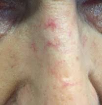 Signs of liver disease as jaundice, palmar erythema, spider nevi, parotid enlargement, ascites, hepatosplenomegaly, encephalopathy, abdominal tenderness. Acd A Z Of Skin Spider Naevi