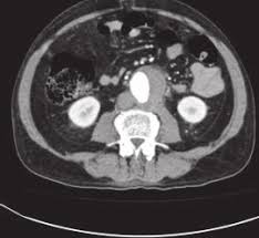 Galeno descreveu dois tipos de aneurisma: En La Tomografia Computadorizada Se Observa Un Aneurisma De La Aorta Download Scientific Diagram