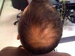 Drug and chemical induced hair loss. Diagnosing Treating And The Outcomes To Hair Loss
