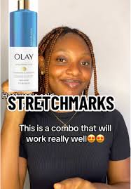 Effective Treatments for Stretch Marks
