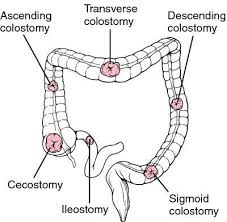 Stoma Definition Of Stoma In The Medical Dictionary By The Free Online Medical Dictionary Thesaurus And Encycloped Medical Dictionary Nursing School Nurse