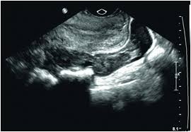 Diagnosing Ectopic Pregnancy In The Emergency Setting