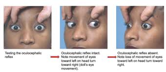 Image result for Oculovestibular Testing
