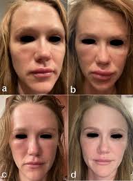 Common side effects from the shingles vaccine usually last no longer than two to three days, they include: Covid 19 Sars Cov 2 Virus Spike Protein Related Delayed Inflammatory Reaction To Hyaluronic Acid Dermal Fillers A Challenging Clinical Conundrum In Diagnosis And Treatment Springerlink