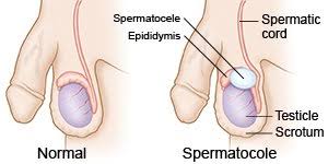 Get the facts with our expert guide. Spermatocele What You Need To Know