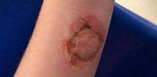 Image result for spinne biss haut reaktion