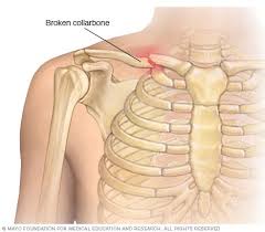 Signs of osteosarcoma include pain in the affected area and a palpable lump or swelling. Broken Collarbone Symptoms And Causes Mayo Clinic