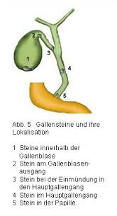 Gallenstein Operation Der Gallenblase Bei Gallensteinen Und Entzundungen