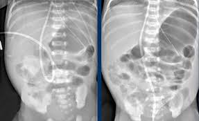 Image result for Necrotizing Enterocolitis