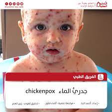 هل هناك حبوب تشبه الجدري المائي. 4572 Ø¬Ø¯Ø±ÙŠ Ø§Ù„Ù…Ø§Ø¡ Chickenpox Ø¬Ù…ÙŠØ¹Ù†Ø§ Ø§Ù„Ø¨Ø§Ø­Ø«ÙˆÙ† Ø§Ù„Ù…Ø³Ù„Ù…ÙˆÙ† Facebook