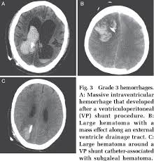 Pdf Hemorrhage Rates Associated With Two Methods Of Ventriculostomy External Ventricular Drainage Vs Ventriculoperitoneal Shunt Procedure Semantic Scholar