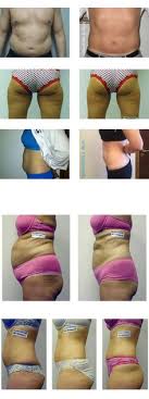 It is an effective way to lose inches and remove stubborn fat from the body. 34 Iloveilipo Ideas Lipo Body Liposuction