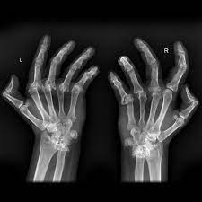 The hallmark feature of this condition is persistent symmetric polyarthritis (synovitis) that affects the hands and feet, though any joint lined by a synovial membrane may be involved. Rheumatoid Arthritis X Ray Wikidoc