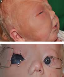 Image result for nevus sclerae