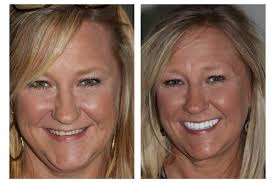 Before & After Photos