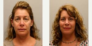 Jill Hessler, MD Reviews, Before and After Photos, Answers