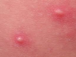Sufficient sanitizer level is crucial to kill the bacteria that cause hot tub folliculitis. Spa Pool Folliculitis Dermnet Nz