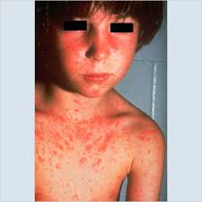 Image result for Rubella
