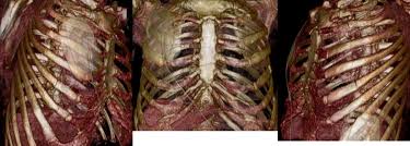 Image result for Flail Chest