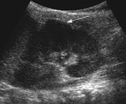 It is usually created by the pressure of surrounding organs to the cortex of the kidney during development. Renal Revision From Lobulation To Duplication What Is Normal Adc Education Practice Edition