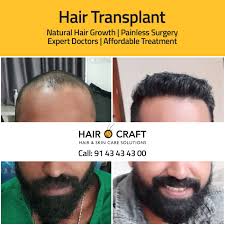 I started taking hair vitamins in january 2016 i was scared at first because i thought it would interfere with my tamoxifen. Hair Transplant Before After Photo Gallery Hairocraft