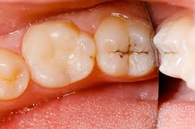Here are the 3 most common types of cavities, along with the appropriate treatment options for each. Tooth Decay Symptons Causes Treatment Nearby Dental