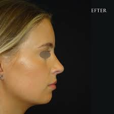 22 årig tjej före och 7 mån efter öppen näsplastik.