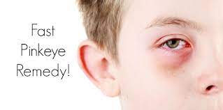 Pinkeye A Fast And Easy Home Remedy Pink Eye Home Remedies Pinkeye Remedies Natural Pink Eye Remedy