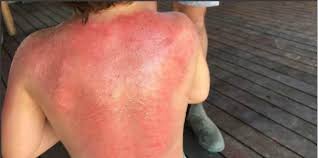 They may be flat, red # the direct application can happen from toothpaste, lip gloss, lipstick, sunscreen, mouthwash or face allergy caused by cellular phones. Sunscreen Allergy Toddler Suffers Horrifying Burns Minutes After Using Sunscreen Theasianparent