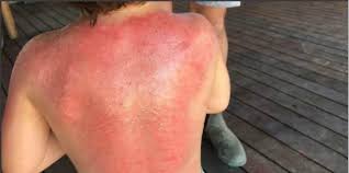 Here's how to figure out which ingredients are the culprits and how you can still protect your skin from uv rays. Sunscreen Allergy Toddler Suffers Horrifying Burns Minutes After Using Sunscreen Theasianparent