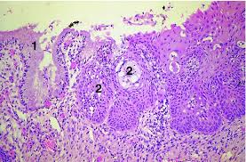 Diagnosis of cervical squamous metaplasia. Colposcopy Of The Normal Cervix A Prerequisite To Establishing The Diagnosis Of Cervical Precancer Obgyn Key
