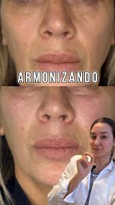 ⚡ La razón por la que tu cara parece más cansada de lo que está…, No  siempre son las ojeras ni las arrugas🙃, Muchas veces, es la pérdida de  volumen en el tercio medio facial., Cuando envejecemos, la ...