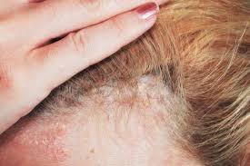 Clinical signs of psoriasis scalp are red flaky spots covering the scalp, inflammatory processes and itching. Scalp Psoriasis Shampoos Home Remedies And Causes