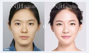 Due to the efficiency and relatively low cost of rhinoplasty in korea, international patients keep traveling to korea for medical tourism. Plastic S Past The Complex Historical And Cultural Influences Underlying South Korea S Plastic Surgery Phenomenon Synergy The Journal Of Contemporary Asian Studies