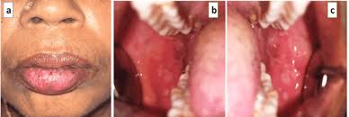 Image result for Erythema Multiforme Major