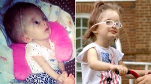 Image result for Hydrocephalus