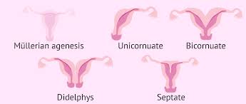 At coitarche, most experience difficulty in achieving. Absence Of Uterus Mayer Rokitansky Kuster Hauser Syndrome