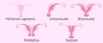 At coitarche, most experience difficulty in achieving. Absence Of Uterus Mayer Rokitansky Kuster Hauser Syndrome