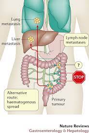 For example, a cancer that is large but has not spread to another body part can also be called What Is The Role Of Lymph Node Metastases In The Progression Of Colorectal Cancer Nature Reviews Gastroenterology Hepatology